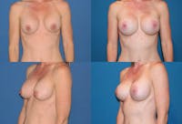 Breast Lift Before & After Gallery - Patient 2158651 - Image 1