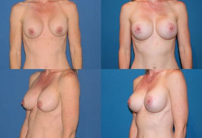 Breast Lift Before & After Gallery - Patient 2158651 - Image 1