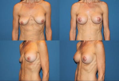 Breast Lift Before & After Gallery - Patient 2158652 - Image 1
