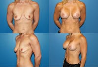 Breast Lift Before & After Gallery - Patient 2158653 - Image 1