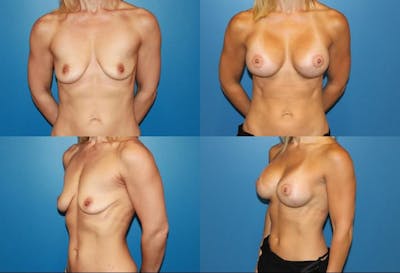 Breast Lift Before & After Gallery - Patient 2158653 - Image 1
