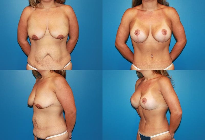 Lollipop Breast Lift with Implants Before & After Gallery - Patient 2388590 - Image 1