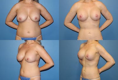Breast Lift Before & After Gallery - Patient 2158656 - Image 1