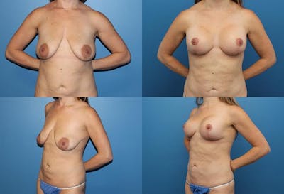 Breast Lift Before & After Gallery - Patient 2158657 - Image 1