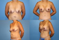 Breast Lift Before & After Gallery - Patient 2158658 - Image 1