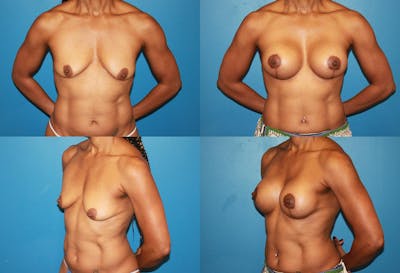 Breast Lift Before & After Gallery - Patient 2158659 - Image 1