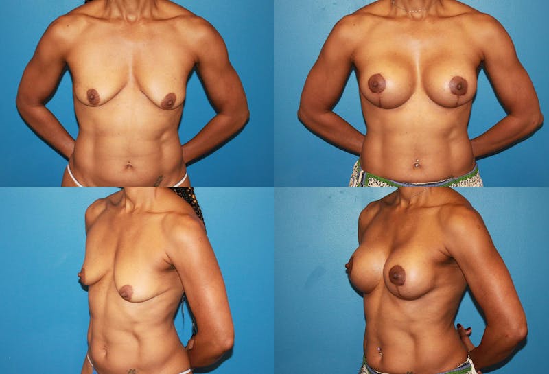 Lollipop Breast Lift with Implants Before & After Gallery - Patient 2388594 - Image 1