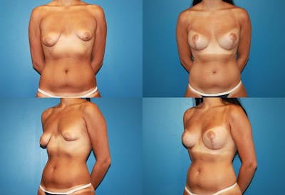 Breast Lift Before & After Gallery - Patient 2158661 - Image 1
