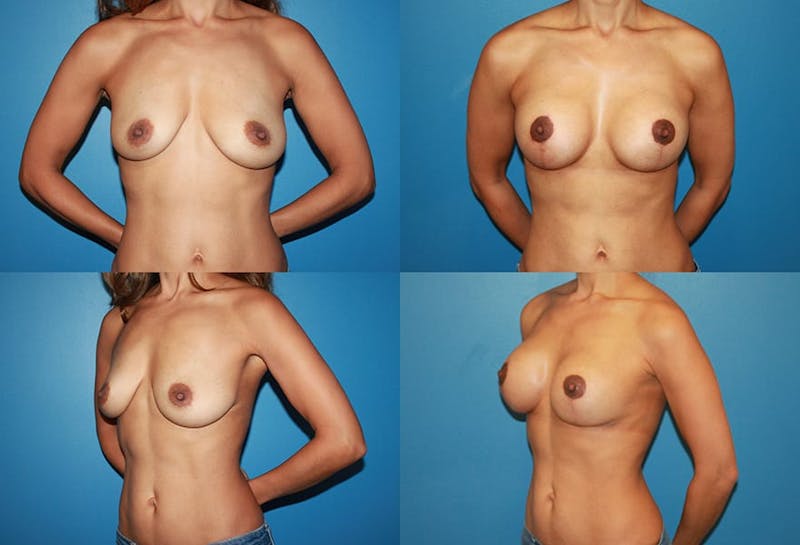 Lollipop Breast Lift with Implants Before & After Gallery - Patient 2388598 - Image 1