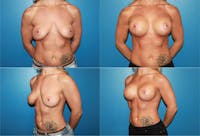 Lollipop Breast Lift with Implants Before & After Gallery - Patient 2388599 - Image 1