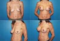 Breast Lift Before & After Gallery - Patient 2158667 - Image 1