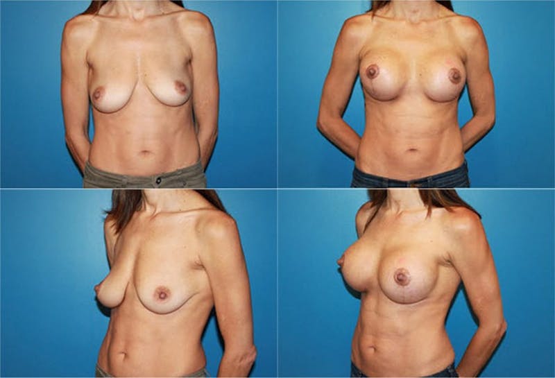 Lollipop Breast Lift with Implants Before & After Gallery - Patient 2388602 - Image 1