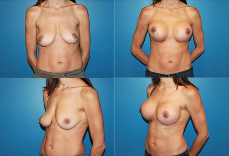 Breast Lift Before & After Gallery - Patient 2158667 - Image 1