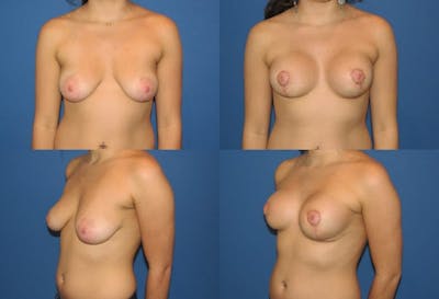 Lollipop Breast Lift with Implants Before & After Gallery - Patient 2388603 - Image 1