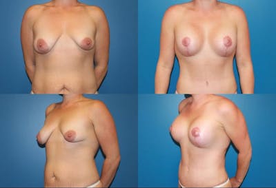 Lollipop Breast Lift with Implants Before & After Gallery - Patient 2388604 - Image 1