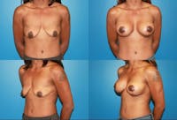 Lollipop Breast Lift with Implants Before & After Gallery - Patient 2388605 - Image 1