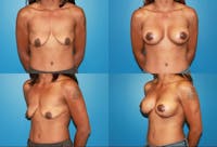 Breast Lift Before & After Gallery - Patient 2158670 - Image 1