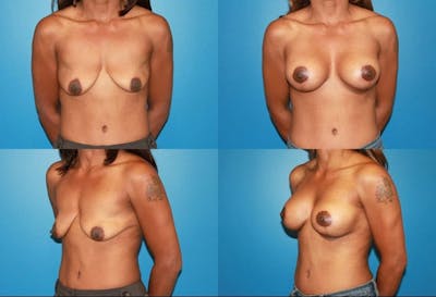 Breast Lift Before & After Gallery - Patient 2158670 - Image 1