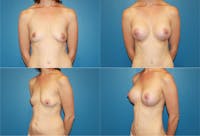 Breast Lift Before & After Gallery - Patient 2158673 - Image 1