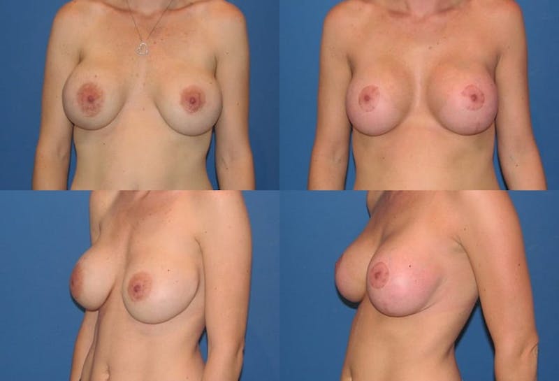 Breast Lift Before & After Gallery - Patient 2158675 - Image 1