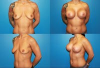 Lollipop Breast Lift with Implants Before & After Gallery - Patient 2388608 - Image 1
