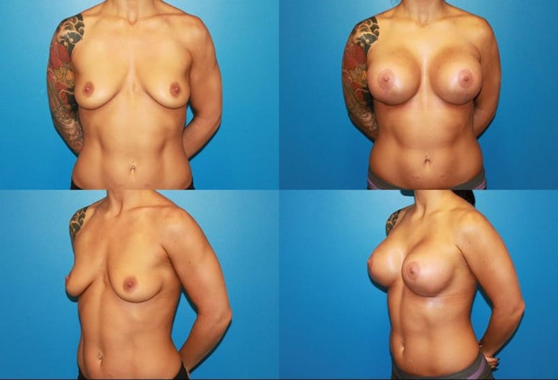 Lollipop Breast Lift with Implants Before & After Gallery - Patient 2388608 - Image 1