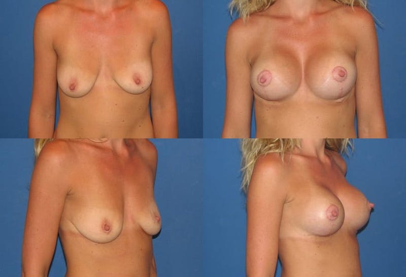 Lollipop Breast Lift with Implants Before & After Gallery - Patient 2388609 - Image 1