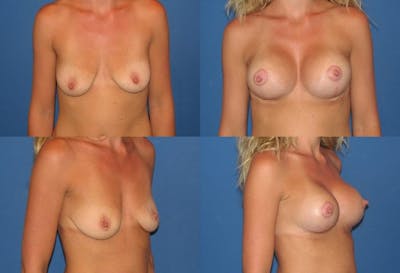 Breast Lift Before & After Gallery - Patient 2158677 - Image 1