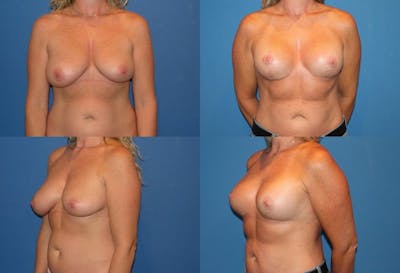 Breast Lift Before & After Gallery - Patient 2158681 - Image 1
