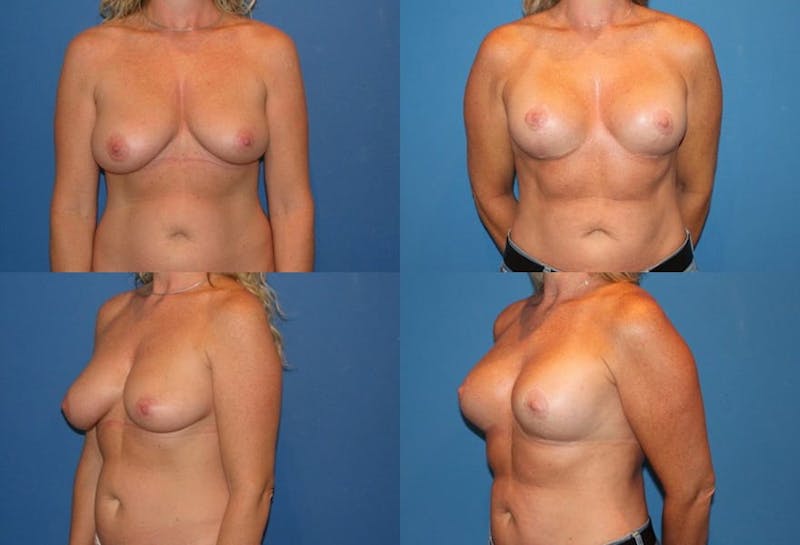Lollipop Breast Lift with Implants Before & After Gallery - Patient 2388612 - Image 1