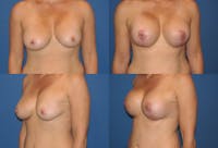 Breast Lift Before & After Gallery - Patient 2158685 - Image 1