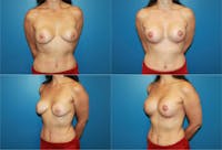 Lollipop Breast Lift with Implants Before & After Gallery - Patient 2388616 - Image 1