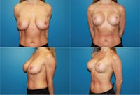 Breast Lift Before & After Gallery - Patient 2158688 - Image 1