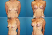 Lollipop Breast Lift with Implants Before & After Gallery - Patient 2388618 - Image 1