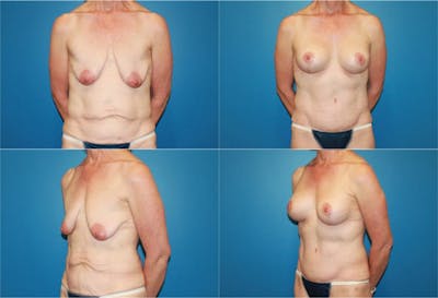 Lollipop Breast Lift with Implants Before & After Gallery - Patient 2388619 - Image 1