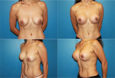 Lollipop Breast Lift with Implants Before & After Gallery - Patient 2388620 - Image 1
