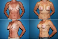 Lollipop Breast Lift with Implants Before & After Gallery - Patient 2388621 - Image 1