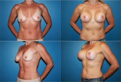 Lollipop Breast Lift with Implants Before & After Gallery - Patient 2388621 - Image 1