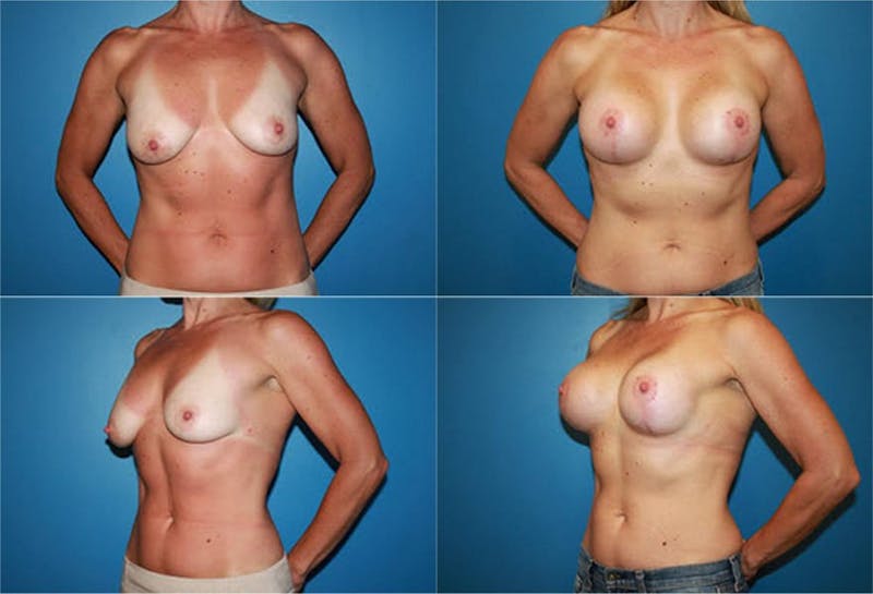 Lollipop Breast Lift with Implants Before & After Gallery - Patient 2388621 - Image 1