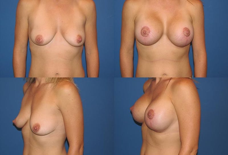 Lollipop Breast Lift with Implants Before & After Gallery - Patient 2388622 - Image 1