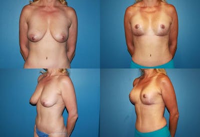Breast Lift Before & After Gallery - Patient 2158697 - Image 1