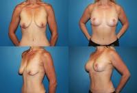 Breast Lift Before & After Gallery - Patient 2158698 - Image 1