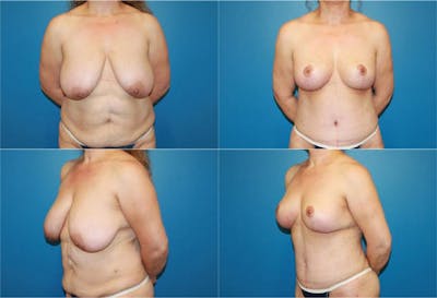 Breast Lift Before & After Gallery - Patient 2158701 - Image 1
