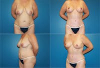 Breast Lift Before & After Gallery - Patient 2158702 - Image 1