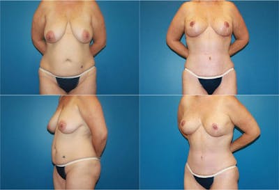 Lollipop Breast Lift with No Implants Before & After Gallery - Patient 2388694 - Image 1