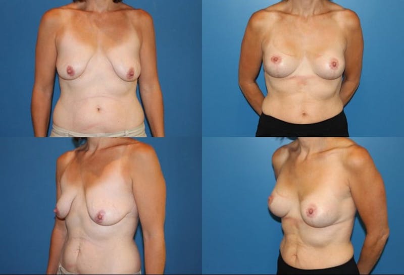 Breast Lift Before & After Gallery - Patient 2158703 - Image 1