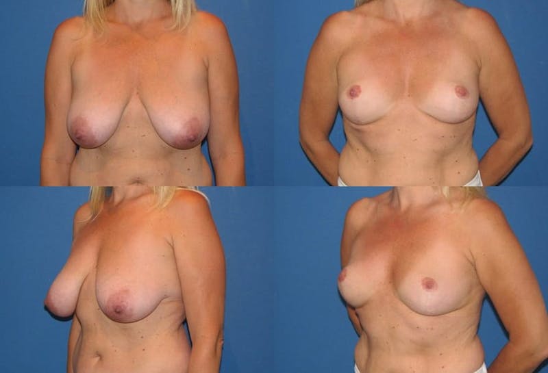 Breast Lift Before & After Gallery - Patient 2158705 - Image 1