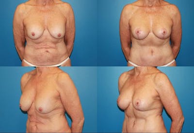 Breast Lift Before & After Gallery - Patient 2158706 - Image 1