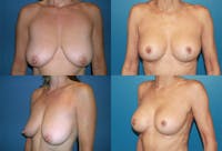 Breast Lift Before & After Gallery - Patient 2158707 - Image 1