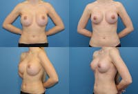 Mal-position- Inferior and/or Lateral Before & After Gallery - Patient 2388917 - Image 1